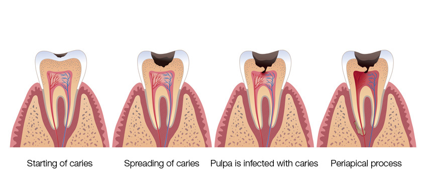 Laser caries removal