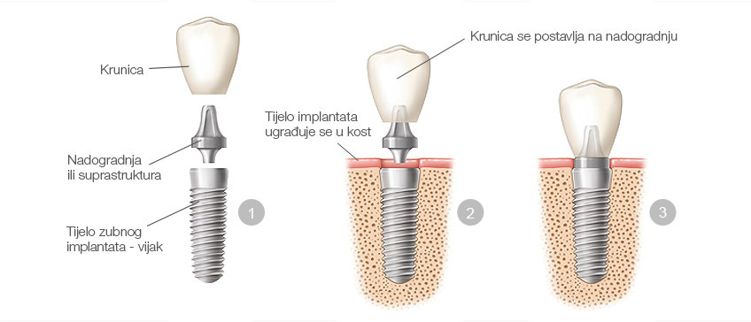 Ugradnja zubnog implantata