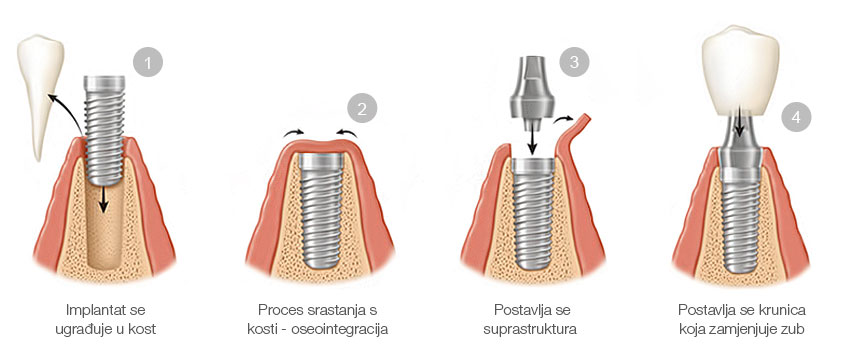 zubni implantati - proces ugradnje
