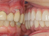 Zubni implantati 6