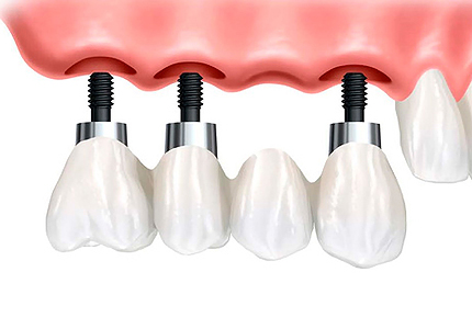 Zubni implantat rješenje za izgubljen zub