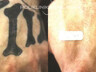 Web_848x364px_Lasersko uklanjanje tetovaža_6