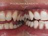 Zoom izbjeljivanje zubi 1